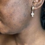 Acne & Pimples